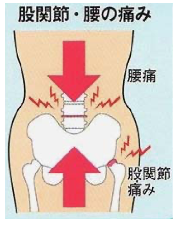 股関節・腰の痛みの図